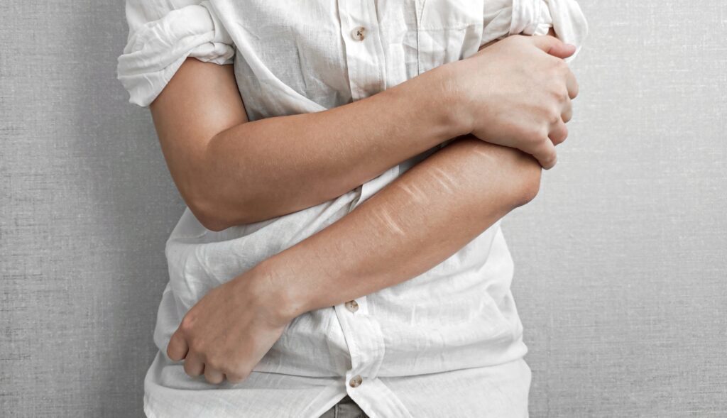 Person with scars on arm